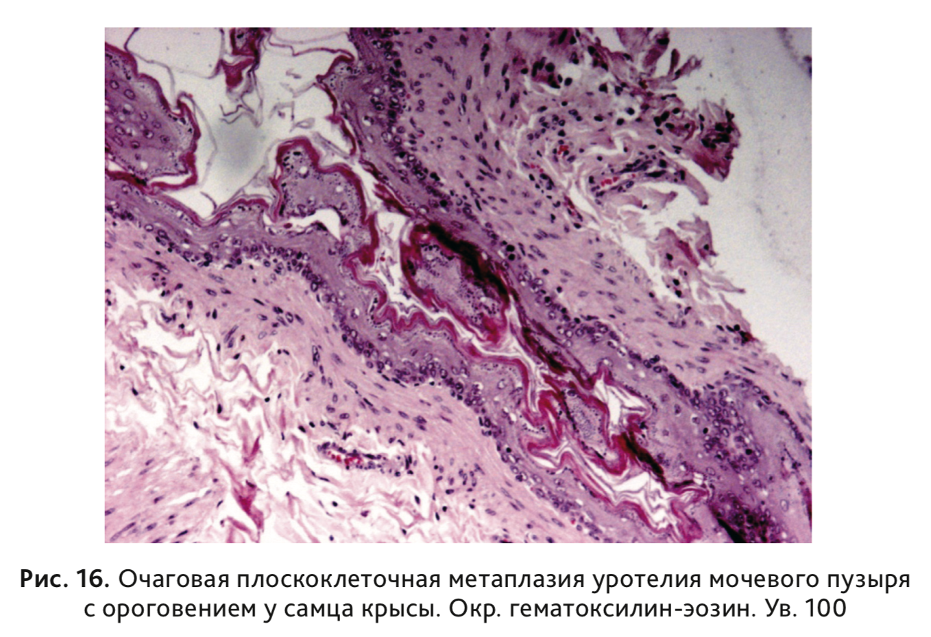 Плоскоклеточный эндометрий. Метаплазия уротелия гистология. Метаплазия эпителия шейки матки цитология. Плоскоклеточная метаплазия гистология. Плоскоклеточная папиллома гистология.