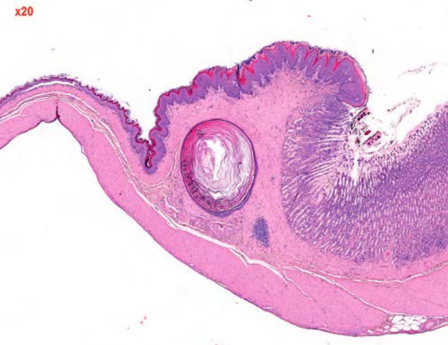  <strong>Рис. 1.</strong> Плоскоклеточная киста в подслизистом слое безжелезистой части желудка у крысы, ×20 (9)