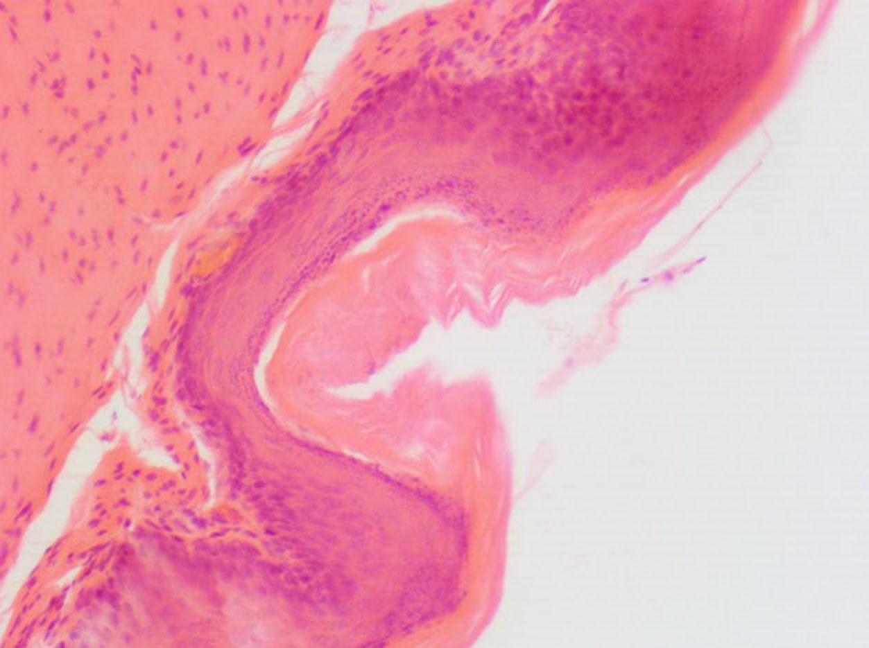  <strong>Рис. 7.</strong> Гиперкератоз в эпителии безжелезистой части желудка на фоне инфекции <em>H. spp.</em> у мыши. Заметно утолщение рогового слоя. Окраска гематоксилином и эозином, ×100