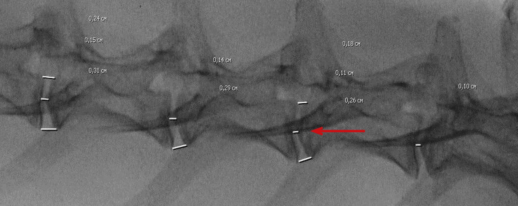  <strong>Рис. 14.</strong> Рентгенологический снимок поясничного отдела кролика (8 нед после индукции патологии). Показаны интактные сегменты L3–L4, L4–L5, L6–L7, красная стрелка указывает на поврежденный сегмент L5–L6) 